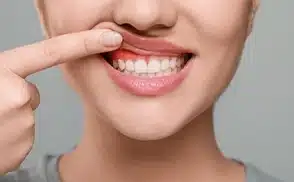 Gingivitis Nedir?
