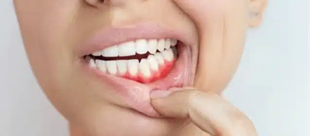 Gingivitis Nedir?