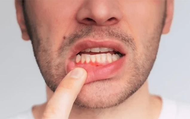 Gingivitis Nedir?