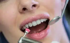 Diş Taşı Temizliği Sonrası​